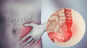 Irritable Bowel Syndrome (IBS)